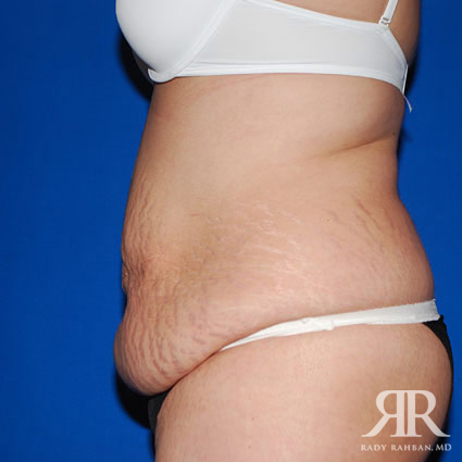 Tummy Tuck