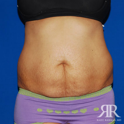 Tummy Tuck