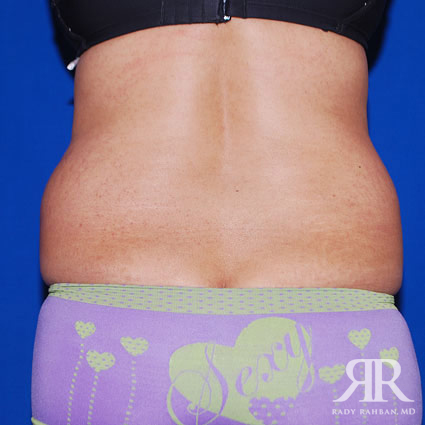 Tummy Tuck