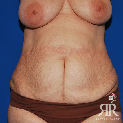 Tummy Tuck