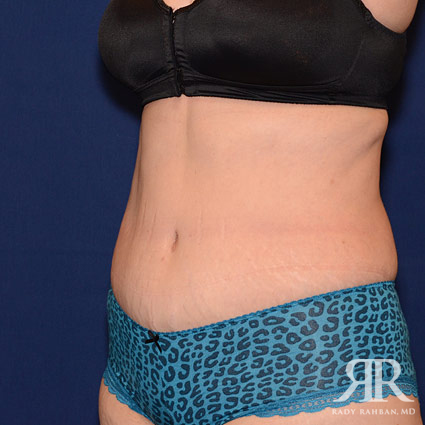 Tummy Tuck