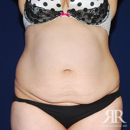 Tummy Tuck