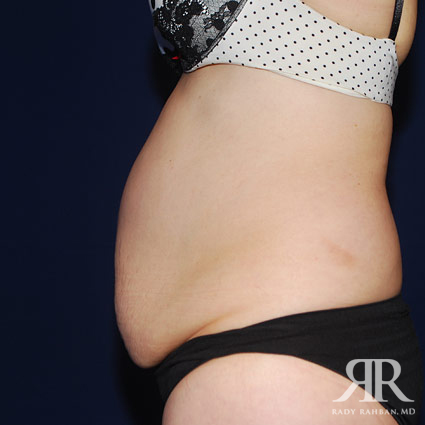 Tummy Tuck