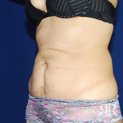 Tummy Tuck