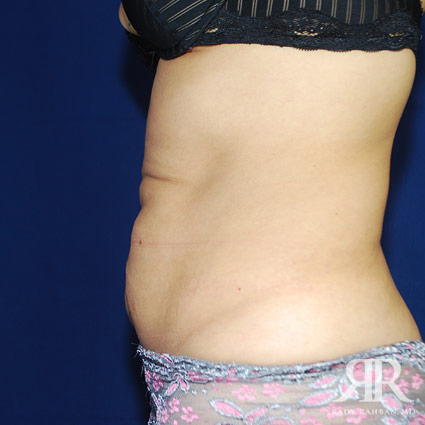 Tummy Tuck