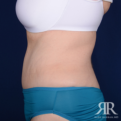 Tummy Tuck