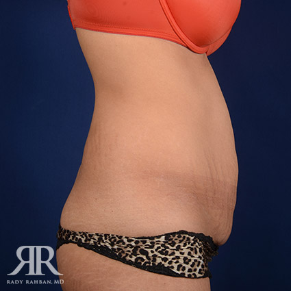 Tummy Tuck