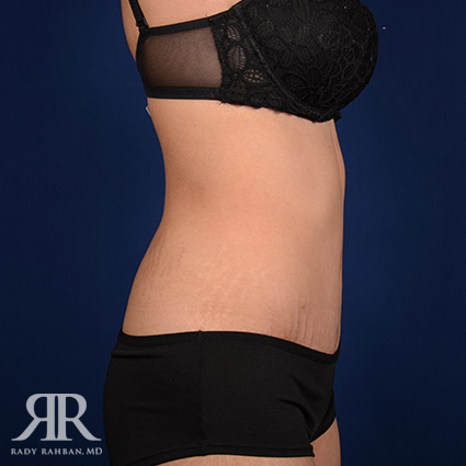 Tummy Tuck