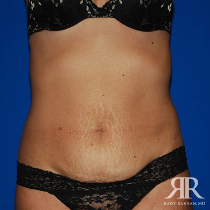 Tummy Tuck