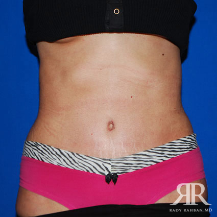 Tummy Tuck