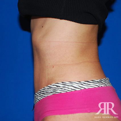 Tummy Tuck