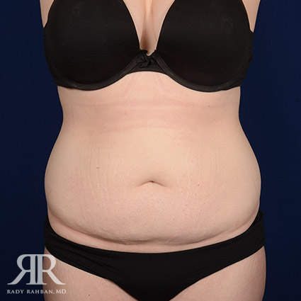 Tummy Tuck