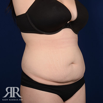 Tummy Tuck