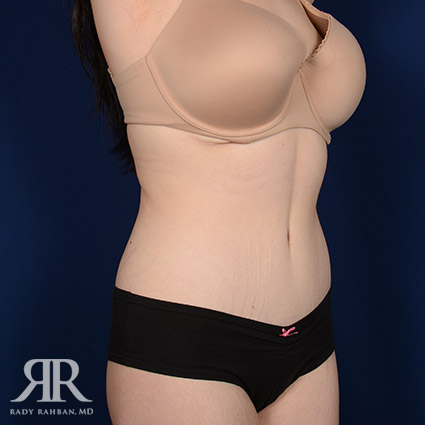 Tummy Tuck