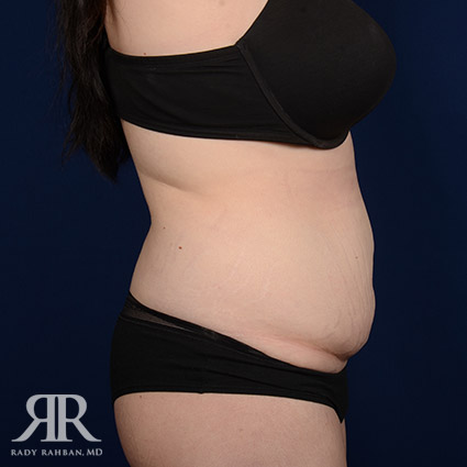 Tummy Tuck