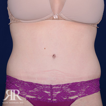 Tummy Tuck