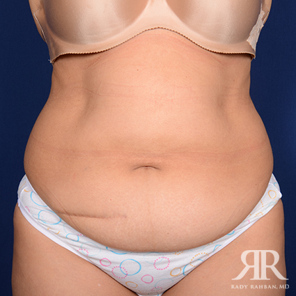 Tummy Tuck