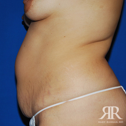 Tummy Tuck