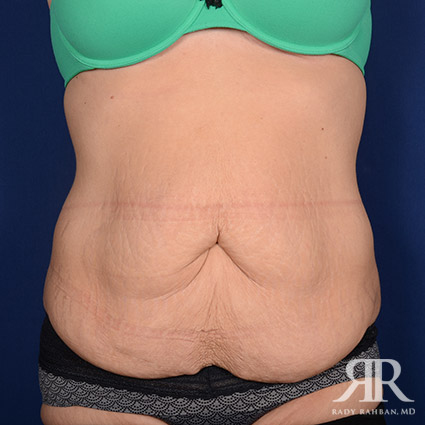 Tummy Tuck