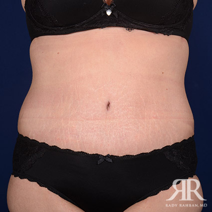 Tummy Tuck