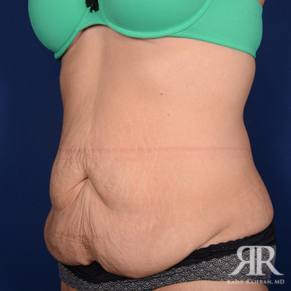 Tummy Tuck