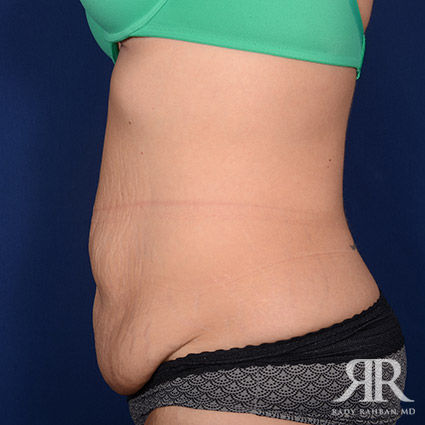 Tummy Tuck