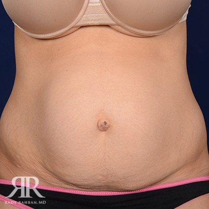 Tummy Tuck