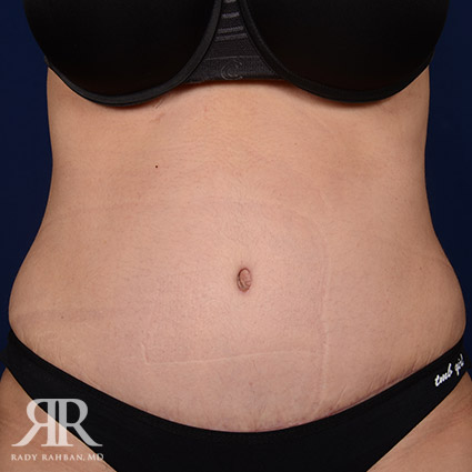 Tummy Tuck