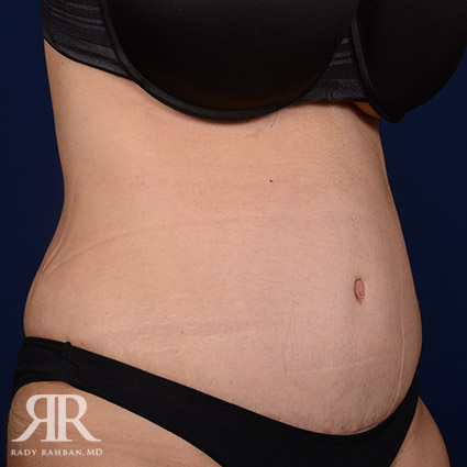 Tummy Tuck