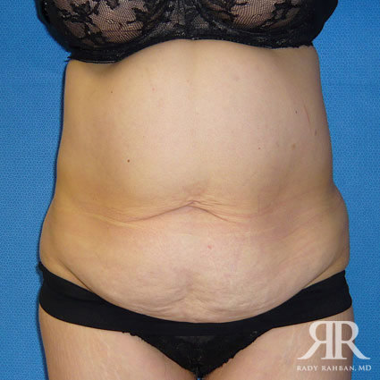 Tummy Tuck