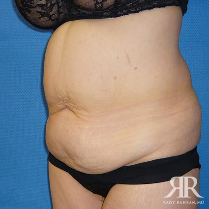 Tummy Tuck