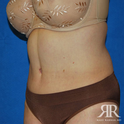 Tummy Tuck