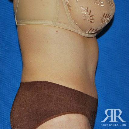 Tummy Tuck