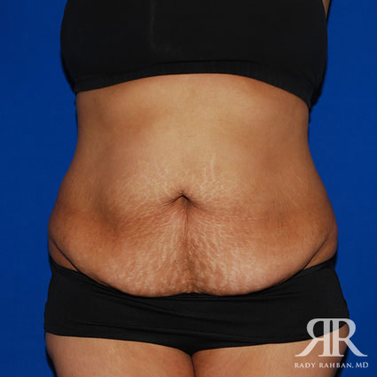 Tummy Tuck