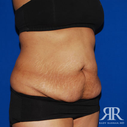 Tummy Tuck