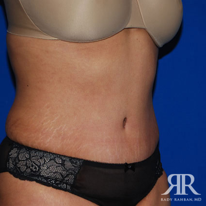 Tummy Tuck