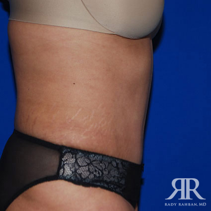 Tummy Tuck