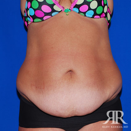 Tummy Tuck