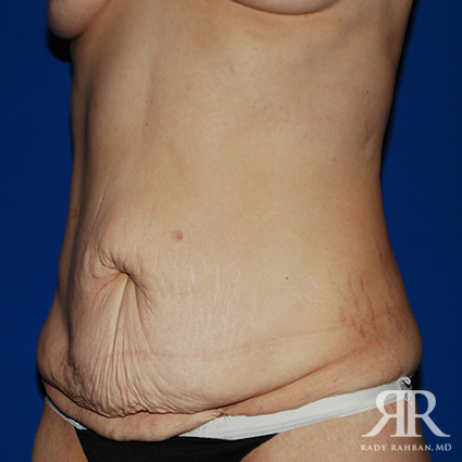 Tummy Tuck