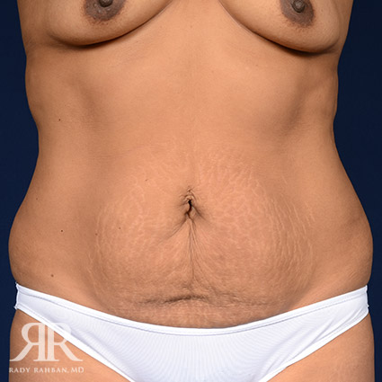 Tummy Tuck