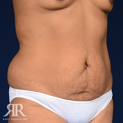 Tummy Tuck