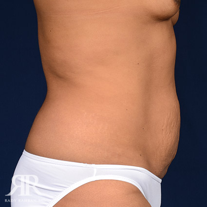 Tummy Tuck