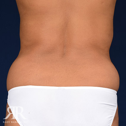 Tummy Tuck