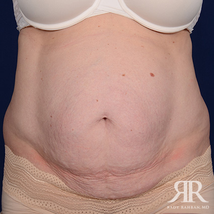 Tummy Tuck