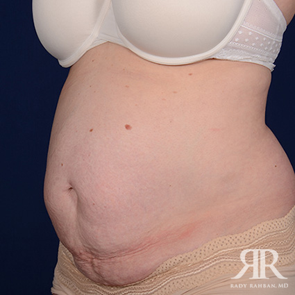 Tummy Tuck