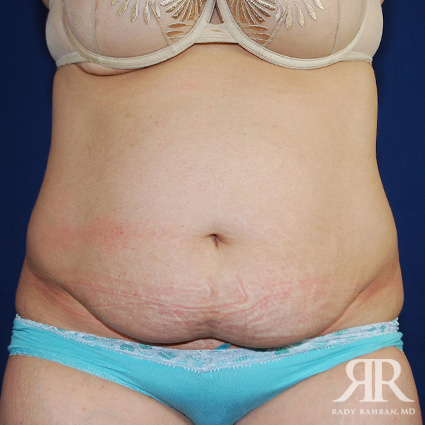 Tummy Tuck