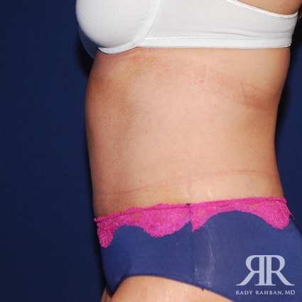 Tummy Tuck