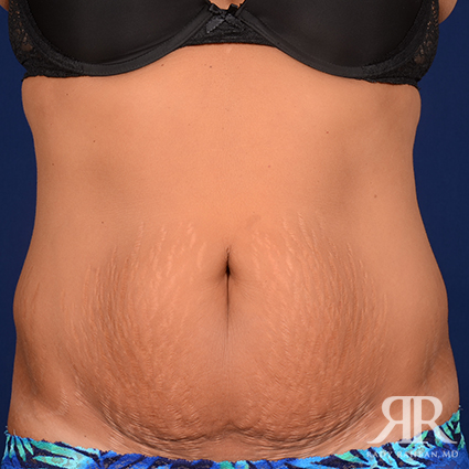 Tummy Tuck