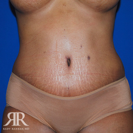 Tummy Tuck