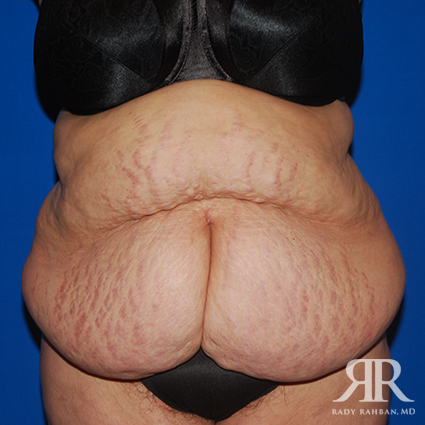 Tummy Tuck